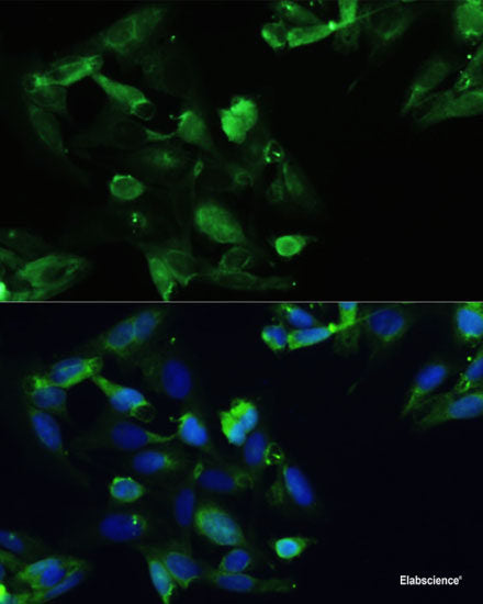 Immunohistochemistry of paraffin-embedded Human lung cancer using HTATSF1 Polyclonal Antibody at dilution of 1:100 (40x lens).