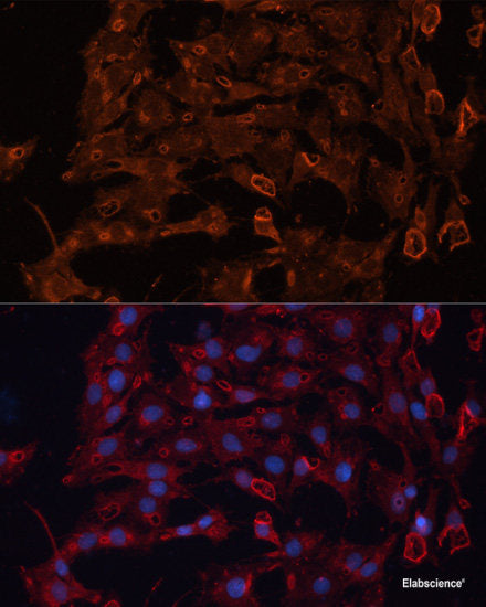 Immunohistochemistry of paraffin-embedded Human gastric cancer using ZEB1 Polyclonal Antibody at dilution of 1:200 (40x lens).