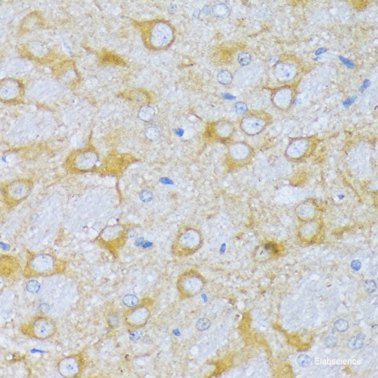 Immunohistochemistry of paraffin-embedded Human lung cancer using ZDHHC18 Polyclonal Antibody at dilution of 1:100 (40x lens).