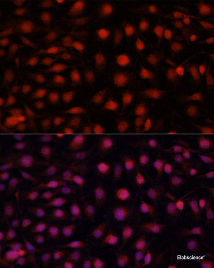 Immunohistochemistry of paraffin-embedded Human lung cancer using RNASE6 Polyclonal Antibody at dilution of 1:100 (40x lens).