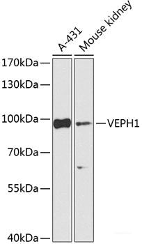 Immunohistochemistry of paraffin-embedded Human liver cancer using PRR11 Polyclonal Antibody at dilution of 1:100 (40x lens).
