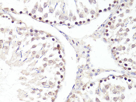 Immunohistochemistry of paraffin-embedded Human colon carcinoma using FAM98A Polyclonal Antibody at dilution of 1:100 (40x lens).