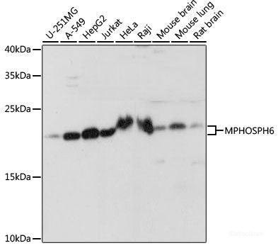 Immunohistochemistry of paraffin-embedded Human liver cancer using CRK Polyclonal Antibody at dilution of 1:200 (40x lens).