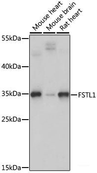 Immunohistochemistry of paraffin-embedded Human lung cancer using MAP3K3 Polyclonal Antibody at dilution of 1:100 (40x lens).