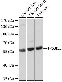 Immunohistochemistry of paraffin-embedded Human breast cancer using Androgen Receptor Polyclonal Antibody at dilution of 1:150 (40x lens).