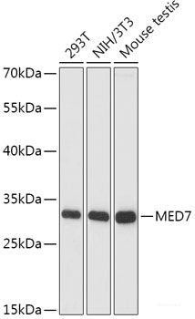 Immunohistochemistry of paraffin-embedded Human liver cancer using SMAD7 Polyclonal Antibody at dilution of 1:100 (40x lens).