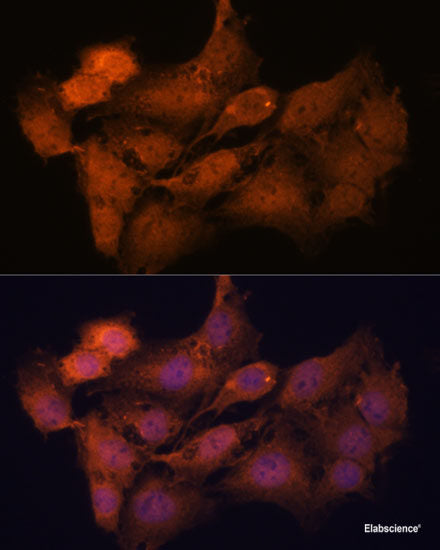 Immunohistochemistry of paraffin-embedded Human lung cancer using MTIF2 Polyclonal Antibody at dilution of 1:100 (40x lens).