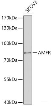 Immunohistochemistry of paraffin-embedded Human breast cancer using PDE4D Polyclonal Antibody at dilution of 1:100 (40x lens).