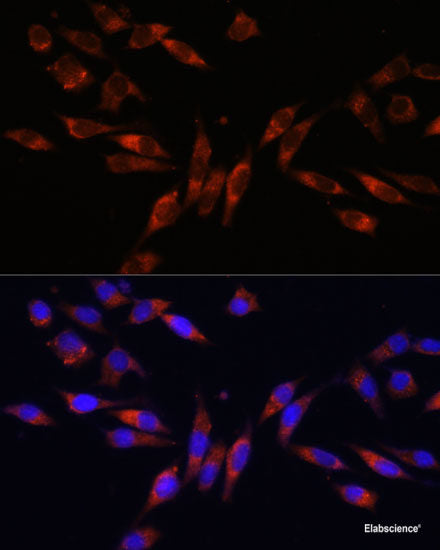 Immunohistochemistry of paraffin-embedded Human liver cancer using UGT1A9 Polyclonal Antibody at dilution of 1:200 (40x lens).