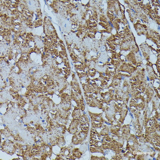Immunohistochemistry of paraffin-embedded Human breast cancer using TERT Polyclonal Antibody at dilution of 1:100 (40x lens).