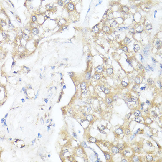 Immunohistochemistry of paraffin-embedded Human breast cancer using EIF4EBP1 Polyclonal Antibody at dilution of 1:100 (40x lens).