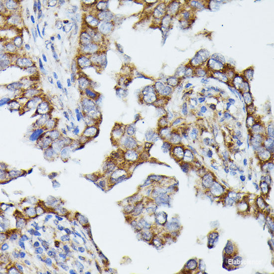 Immunohistochemistry of paraffin-embedded Human lung cancer using ERK1 / ERK2 Polyclonal Antibody at dilution of 1:200 (40x lens).