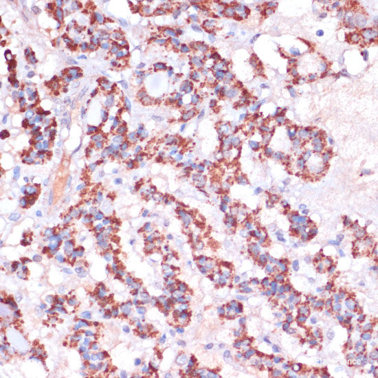 Immunohistochemistry of paraffin-embedded Human breast cancer using DNMT1 Polyclonal Antibody at dilution of 1:200 (40x lens).