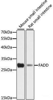 Immunohistochemistry of paraffin-embedded Human liver cancer using Bcl-2 Polyclonal Antibody at dilution of 1:200 (40x lens).