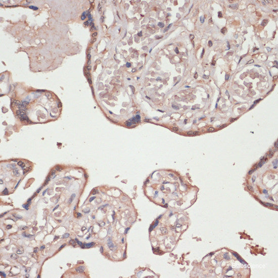 Immunohistochemistry of paraffin-embedded Human colon carcinoma using p53 Polyclonal Antibody at dilution of 1:200 (40x lens).