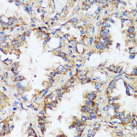 Immunohistochemistry of paraffin-embedded Human breast cancer using CADPS Polyclonal Antibody at dilution of 1:100 (40x lens).