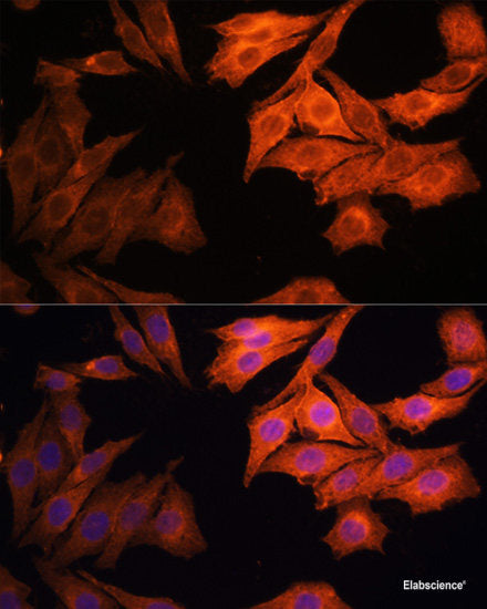 Immunohistochemistry of paraffin-embedded Human breast cancer using PRMT7 Polyclonal Antibody at dilution of 1:200 (40x lens).