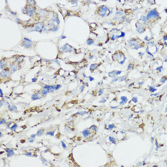 Immunohistochemistry of paraffin-embedded Human breast cancer using BRK1 Polyclonal Antibody at dilution of 1:100 (40x lens).