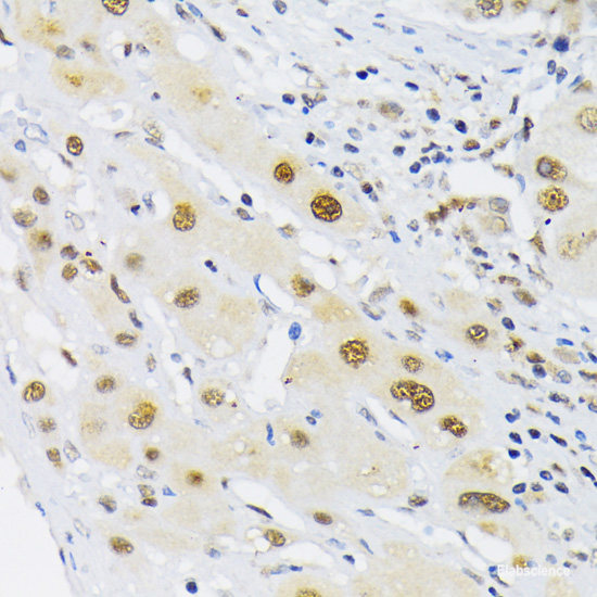 Immunohistochemistry of paraffin-embedded Human colon carcinoma using UBE2O Polyclonal Antibody at dilution of 1:100 (40x lens).