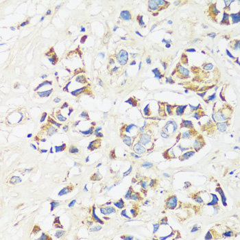 Immunohistochemistry of paraffin-embedded Human breast cancer using BUB1B Polyclonal Antibody at dilution of 1:200 (40x lens).
