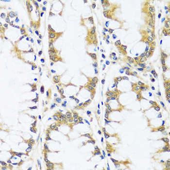 Immunohistochemistry of paraffin-embedded Human gastric cancer using PTGIR Polyclonal Antibody at dilution of 1:200 (40x lens).