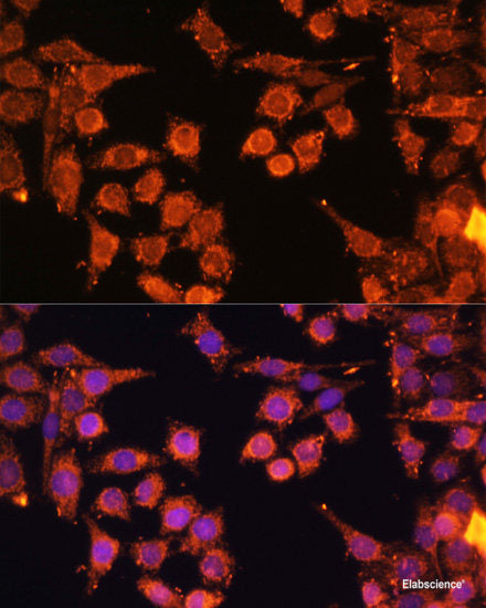 Immunohistochemistry of paraffin-embedded Human liver cancer using CES1 Polyclonal Antibody at dilution of 1:100 (40x lens).