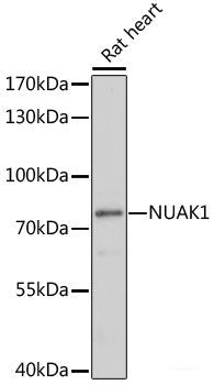 Immunohistochemistry of paraffin-embedded Human liver cancer using DKC1 Polyclonal Antibody at dilution of 1:200 (40x lens).