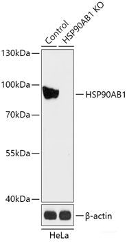Immunohistochemistry of paraffin-embedded Human liver cancer using TIRAP Polyclonal Antibody at dilution of 1:200 (40x lens).