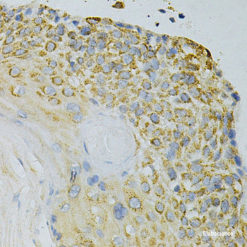 Immunohistochemistry of paraffin-embedded Human lung cancer using Ki67 Polyclonal Antibody at dilution of 1:200 (40x lens).
