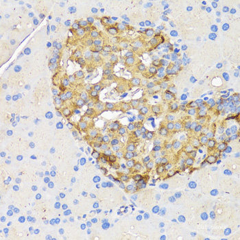 Immunohistochemistry of paraffin-embedded Human lung cancer using UHRF1 Polyclonal Antibody at dilution of 1:100 (40x lens).