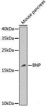 Immunohistochemistry of paraffin-embedded Human thyroid cancer using SNCG Polyclonal Antibody at dilution of 1:200 (40x lens).