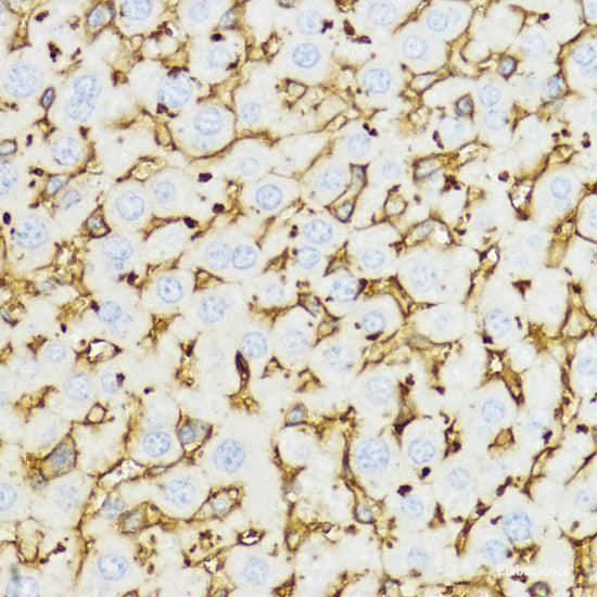 Immunohistochemistry of paraffin-embedded Human breast cancer using DGKQ Polyclonal Antibody at dilution of 1:100 (40x lens).