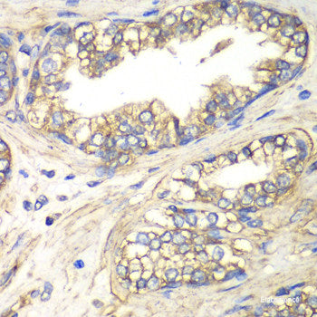 Immunofluorescence analysis of Human lung cancer cells using SCNN1A Polyclonal Antibody at dilution of 1:100. Blue: DAPI for nuclear staining.