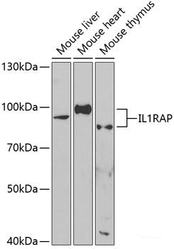 Immunohistochemistry of paraffin-embedded Human kidney cancer using UGT1A4 Polyclonal Antibody at dilution of 1:200 (40x lens).