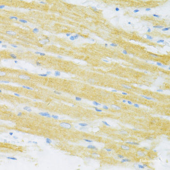 Immunohistochemistry of paraffin-embedded Human mammary cancer using ZEB1 Polyclonal Antibody at dilution of 1:200 (40x lens).