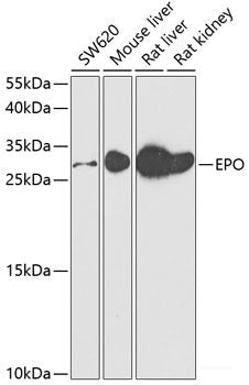 Immunohistochemistry of paraffin-embedded Human lung cancer using SMARCAD1 Polyclonal Antibody at dilution of 1:100 (40x lens).