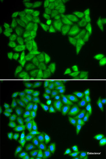Immunohistochemistry of paraffin-embedded Human liver cancer using HAGH Polyclonal Antibody at dilution of 1:100 (40x lens).