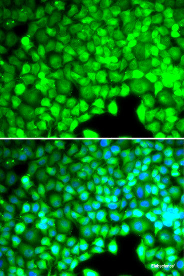 Immunohistochemistry of paraffin-embedded Human well-differentiated squamous skin carcinoma using PHIP Polyclonal Antibody at dilution of 1:100 (40x lens).