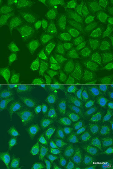 Immunohistochemistry of paraffin-embedded Human gastric cancer using NDUFS7 Polyclonal Antibody at dilution of 1:100 (40x lens).