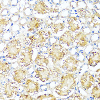 Immunohistochemistry of paraffin-embedded Human liver cancer using XPC Polyclonal Antibody at dilution of 1:100 (40x lens).