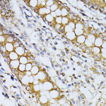 Immunohistochemistry of paraffin-embedded Human liver damage using ZBTB17 Polyclonal Antibody at dilution of 1:100 (40x lens).