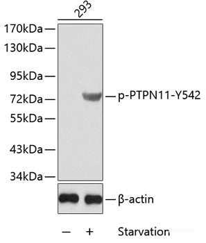 Immunohistochemistry analysis of paraffin-embedded human lung cancer using p27 Polyclonal Antibody at dilution of 1:200.