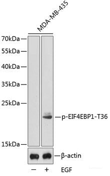 Immunohistochemistry analysis of paraffin-embedded human colon cancer using MMP2 Polyclonal Antibody at dilution of 1:500.