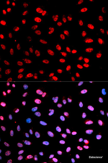 Immunohistochemistry analysis of paraffin-embedded human liver cancer using DNMT1 Polyclonal Antibody at dilution of 1:300.