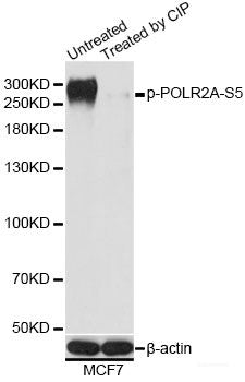 Immunohistochemistry analysis of paraffin-embedded human lung cancer using IKK alpha Polyclonal Antibody at dilution of 1:300.