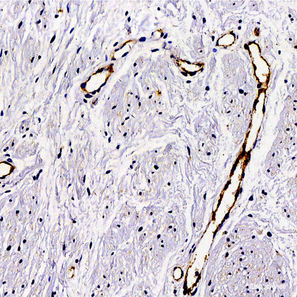 Immunohistochemistry analysis of paraffin-embedded human liver cancer using VDAC1 Polyclonal Antibody at dilution of 1:200.
