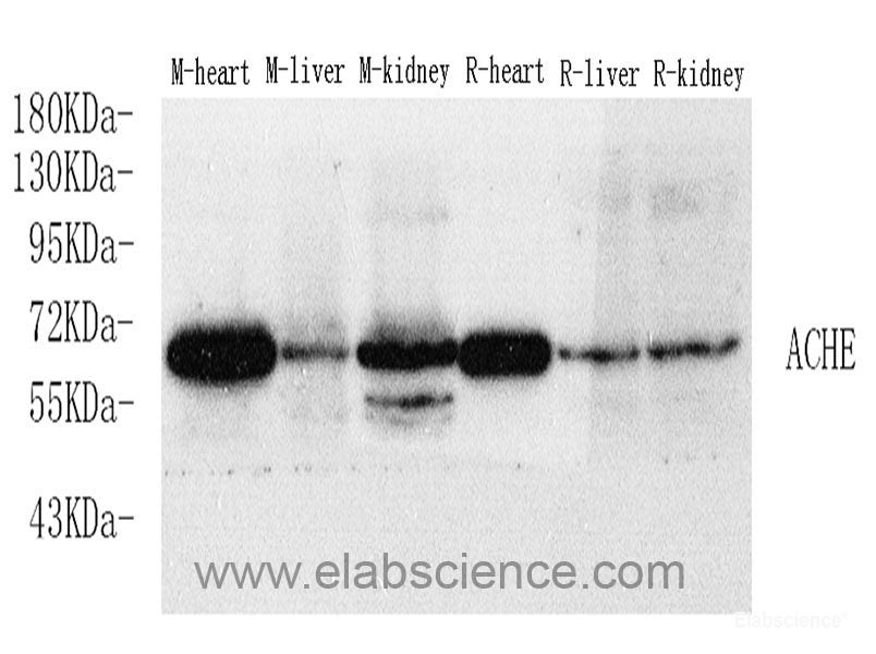 Immunohistochemistry analysis of paraffin-embedded human lung cancer using p27 Polyclonal Antibody at dilution of 1:400.