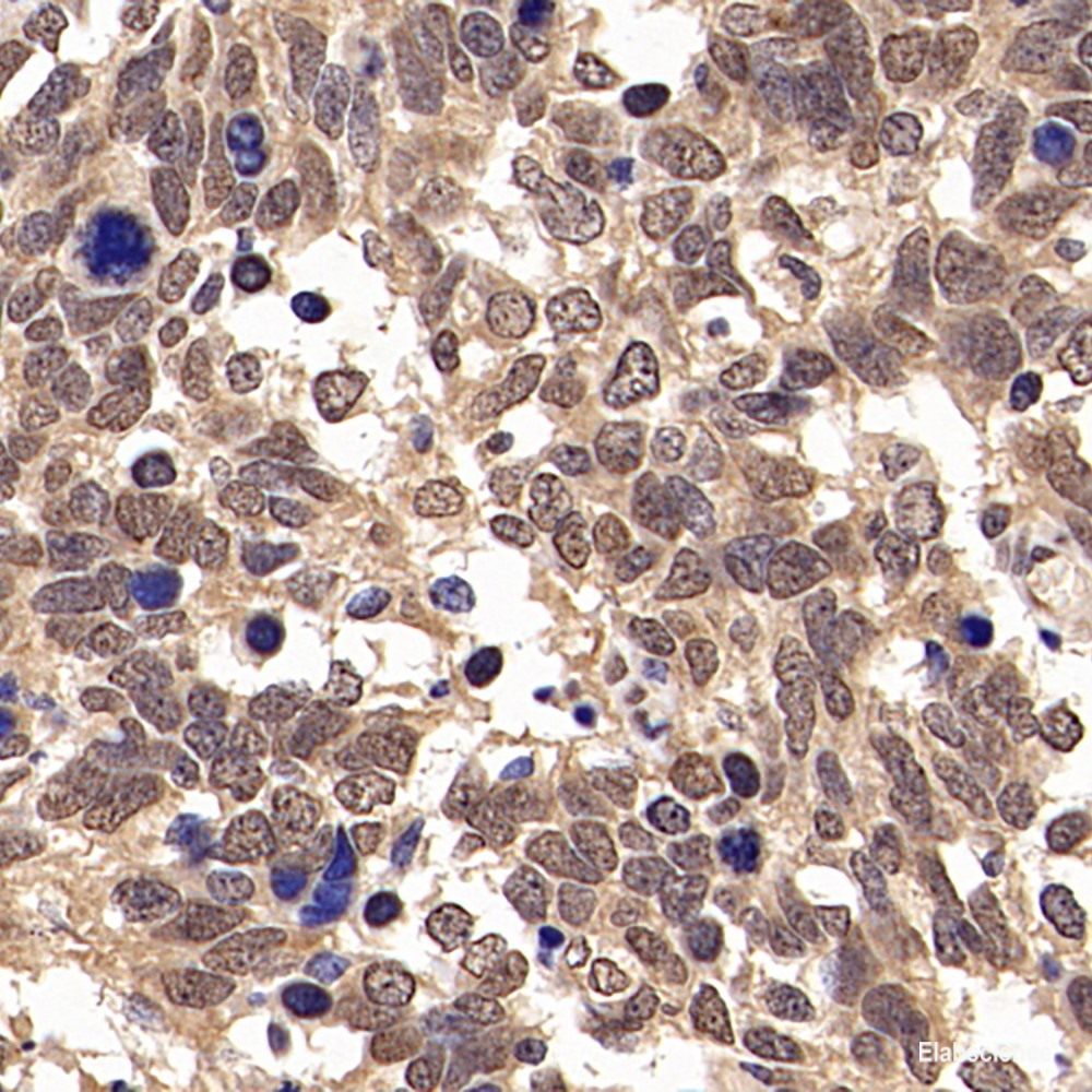 Immunohistochemistry analysis of paraffin-embedded human liver cancer using ITGAV Polyclonal Antibody at dilution of 1:300.