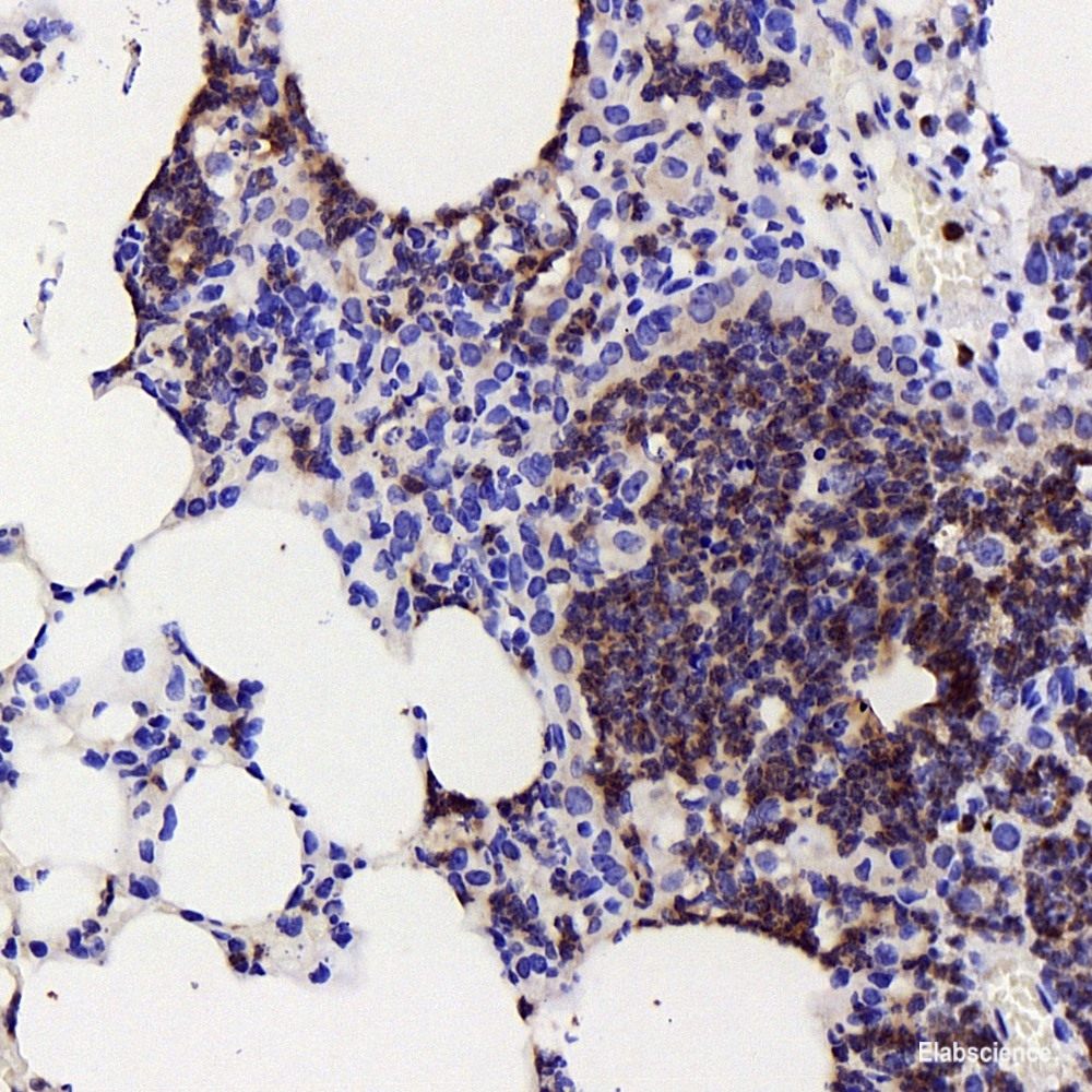 Immunohistochemistry analysis of paraffin-embedded human liver cancer using TEK Polyclonal Antibody at dilution of 1:200.