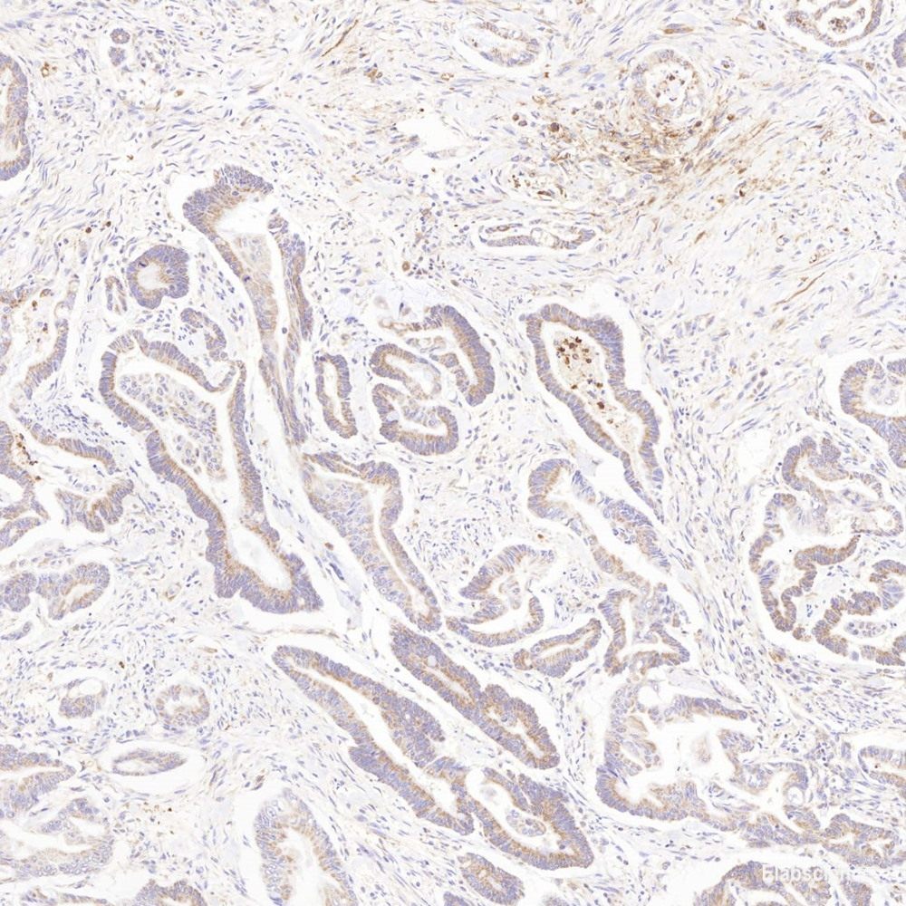 Immunohistochemistry analysis of paraffin-embedded human lung cancer using CREB1 Polyclonal Antibody at dilution of 1:200.